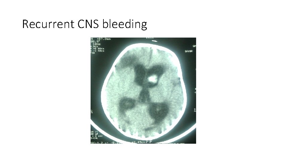 Recurrent CNS bleeding Recurrent CNS bleeding