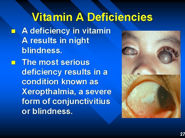 Vitamin A Deficiencies n n A deficiency in vitamin A results in night blindness.