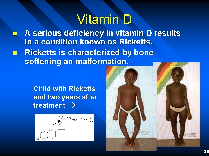 Vitamin D n n A serious deficiency in vitamin D results in a condition Vitamin D n n A serious deficiency in vitamin D results in a condition