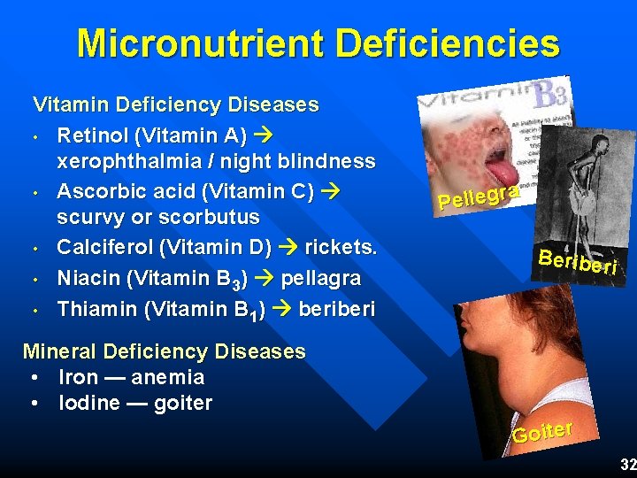 Micronutrient Deficiencies Vitamin Deficiency Diseases • Retinol (Vitamin A) xerophthalmia / night blindness •