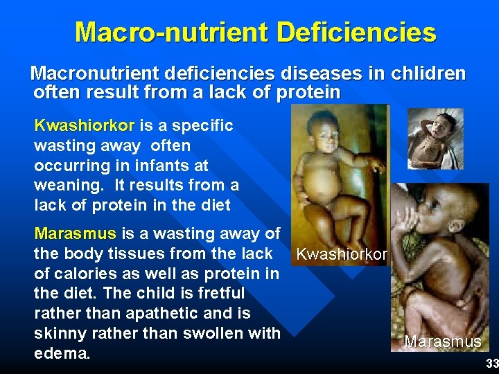 Macro-nutrient Deficiencies Macronutrient deficiencies diseases in chlidren often result from a lack of protein