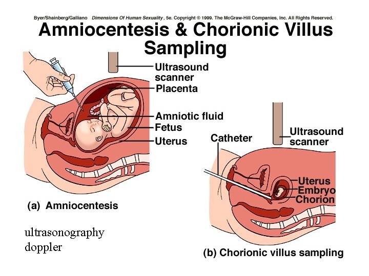 ultrasonography doppler 