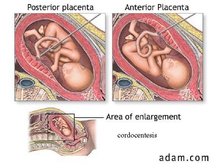 cordocentesis 