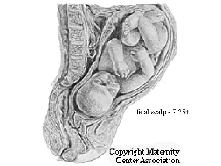 fetal scalp - 7. 25+ 