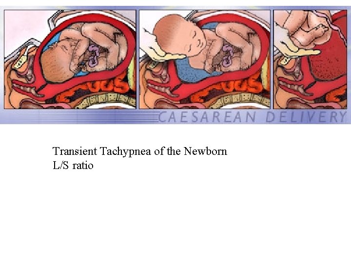 Transient Tachypnea of the Newborn L/S ratio 