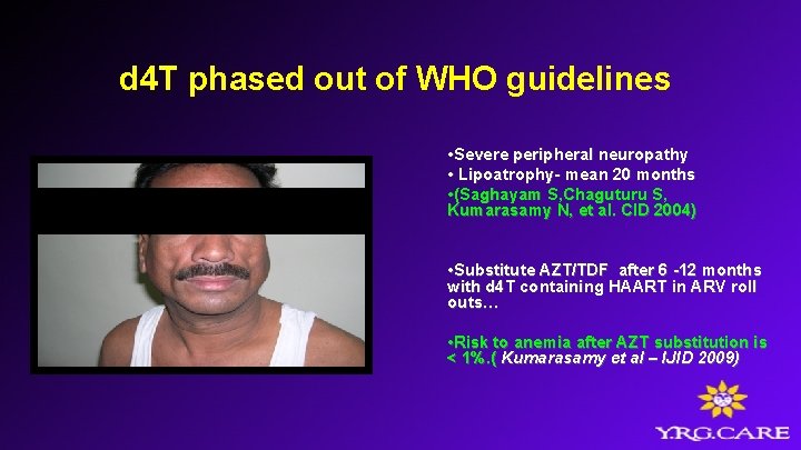 d 4 T phased out of WHO guidelines • Severe peripheral neuropathy • Lipoatrophy-