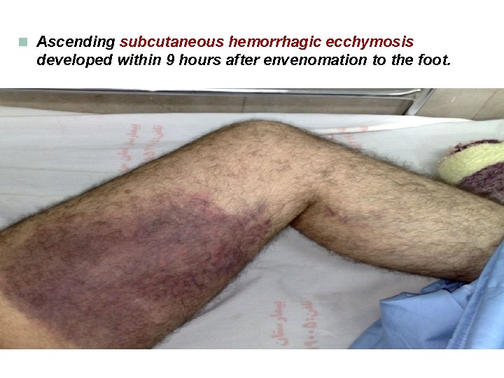 n Ascending subcutaneous hemorrhagic ecchymosis developed within 9 hours after envenomation to the foot.