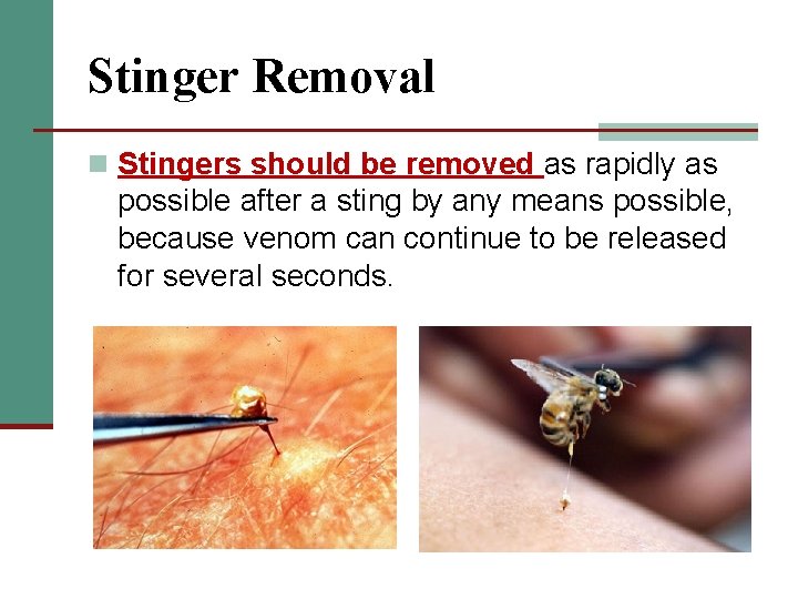 Stinger Removal n Stingers should be removed as rapidly as possible after a sting