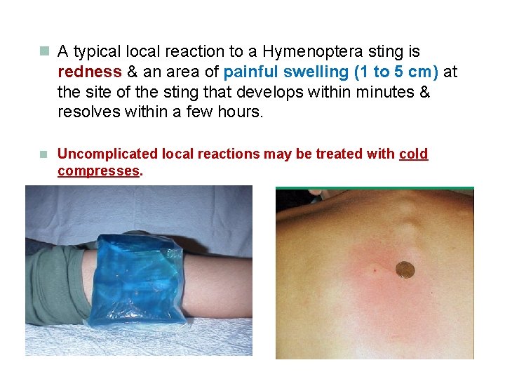 n A typical local reaction to a Hymenoptera sting is redness & an area