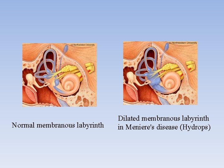 Normal membranous labyrinth Dilated membranous labyrinth in Meniere's disease (Hydrops) 