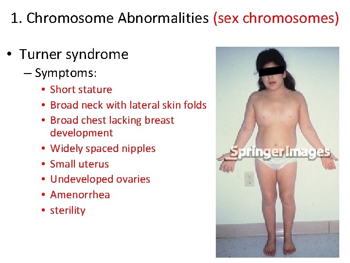 1. Chromosome Abnormalities (sex chromosomes) • Turner syndrome – Symptoms: • Short stature • 1. Chromosome Abnormalities (sex chromosomes) • Turner syndrome – Symptoms: • Short stature •