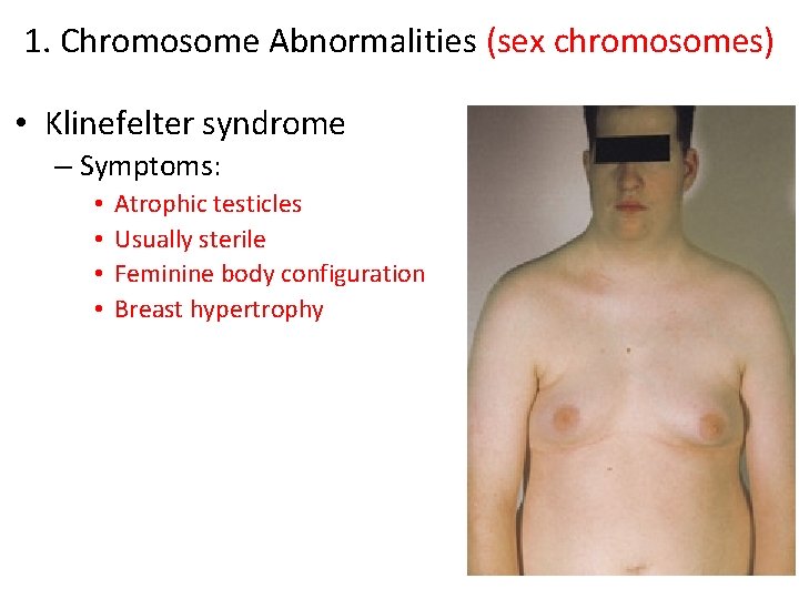 1. Chromosome Abnormalities (sex chromosomes) • Klinefelter syndrome – Symptoms: • • Atrophic testicles 1. Chromosome Abnormalities (sex chromosomes) • Klinefelter syndrome – Symptoms: • • Atrophic testicles