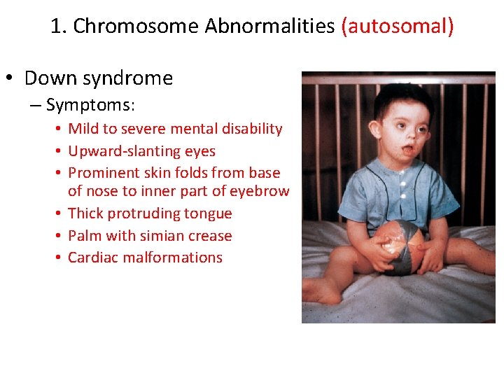 1. Chromosome Abnormalities (autosomal) • Down syndrome – Symptoms: • Mild to severe mental 1. Chromosome Abnormalities (autosomal) • Down syndrome – Symptoms: • Mild to severe mental