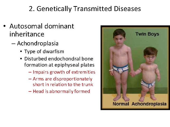 2. Genetically Transmitted Diseases • Autosomal dominant inheritance – Achondroplasia • Type of dwarfism 2. Genetically Transmitted Diseases • Autosomal dominant inheritance – Achondroplasia • Type of dwarfism