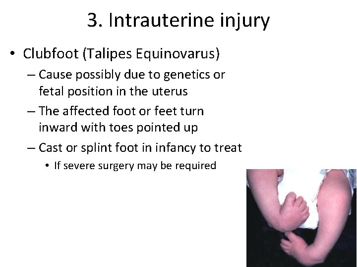 3. Intrauterine injury • Clubfoot (Talipes Equinovarus) – Cause possibly due to genetics or 3. Intrauterine injury • Clubfoot (Talipes Equinovarus) – Cause possibly due to genetics or