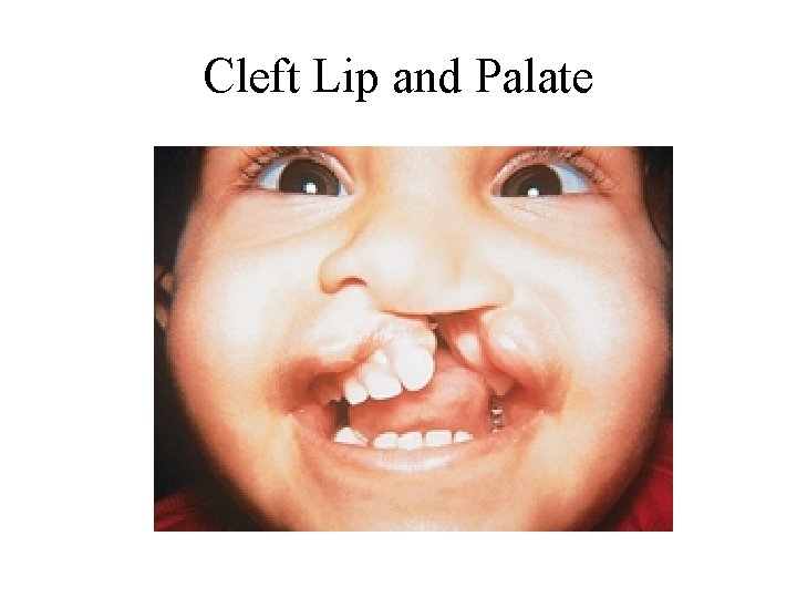 Cleft Lip and Palate Cleft Lip and Palate
