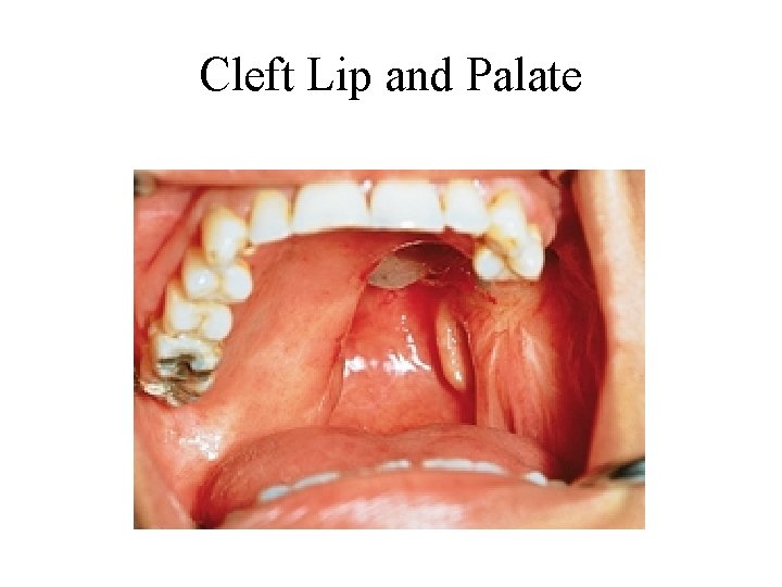 Cleft Lip and Palate Cleft Lip and Palate