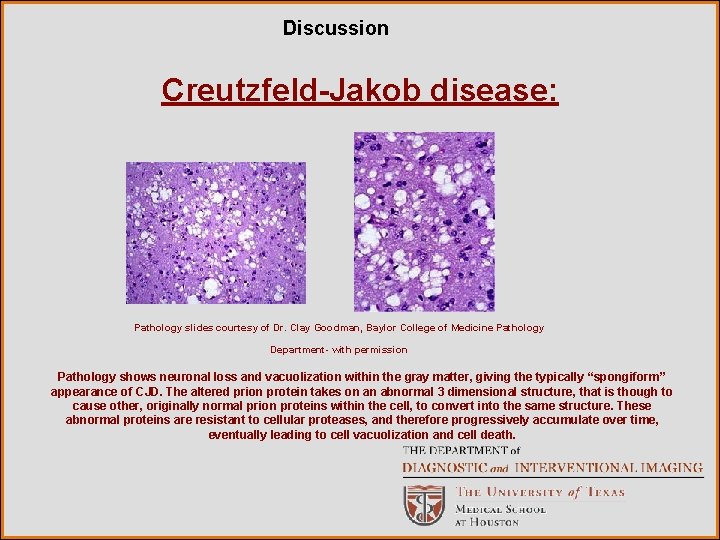 Discussion Creutzfeld-Jakob disease: Pathology slides courtesy of Dr. Clay Goodman, Baylor College of Medicine