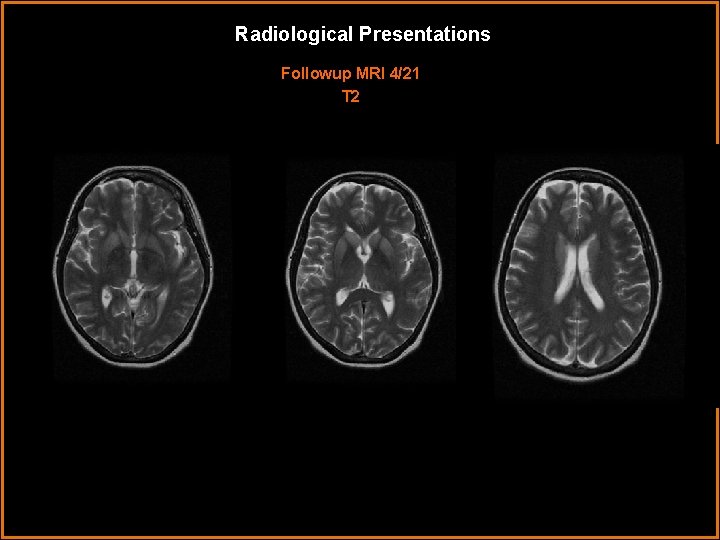 Radiological Presentations Followup MRI 4/21 T 2 