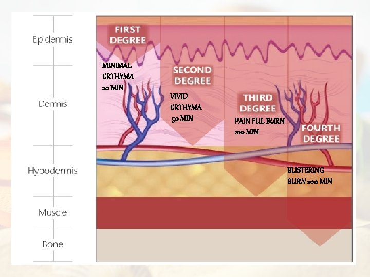 MINIMAL ERTHYMA 20 MIN VIVID ERTHYMA 50 MIN PAIN FUL BURN 100 MIN BLISTERING