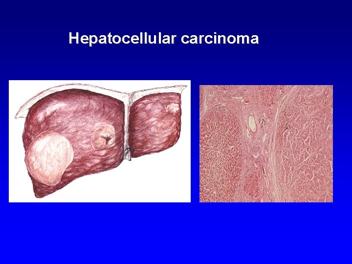 Hepatocellular carcinoma 