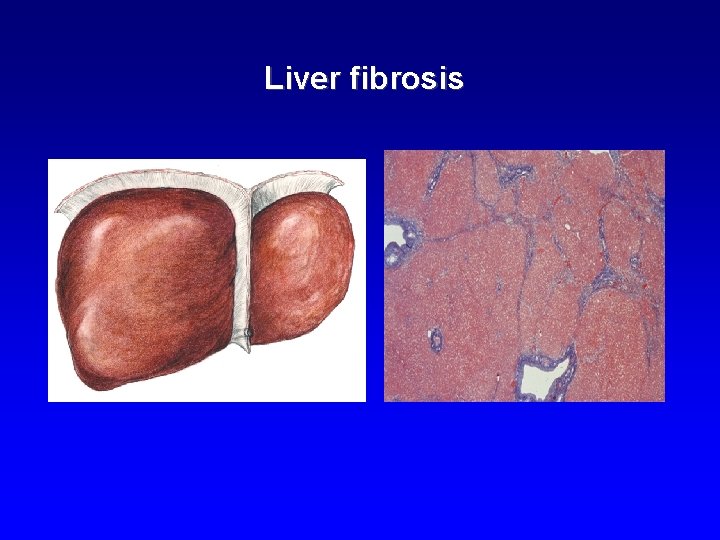 Liver fibrosis 