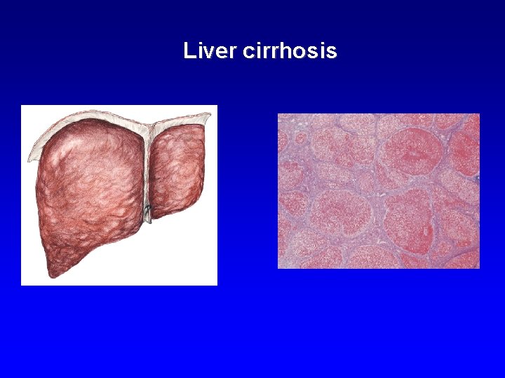 Liver cirrhosis 