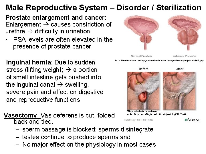 Male Reproductive System – Disorder / Sterilization Prostate enlargement and cancer: Enlargement causes constriction