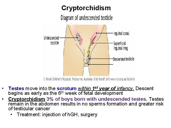 Cryptorchidism • Testes move into the scrotum within 1 st year of infancy. Descent