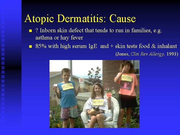 Atopic Dermatitis: Cause n n ? Inborn skin defect that tends to run in