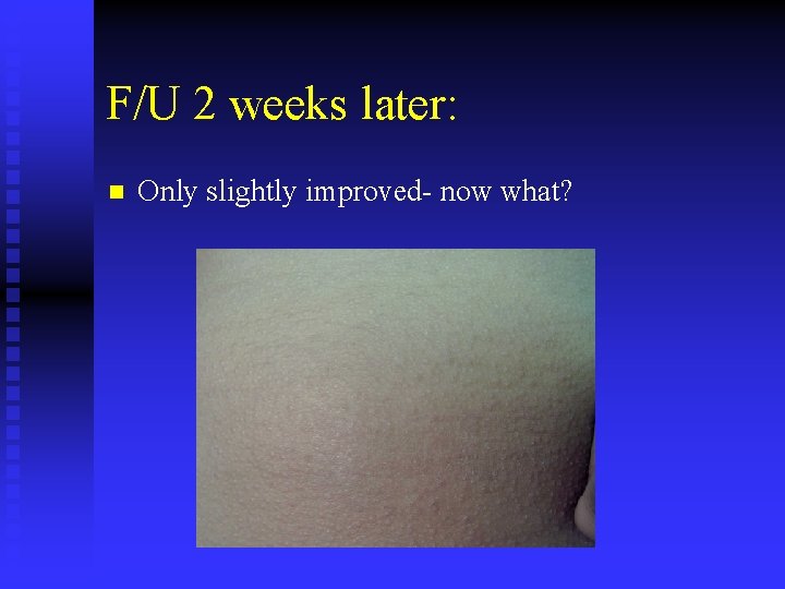 F/U 2 weeks later: n Only slightly improved- now what? 