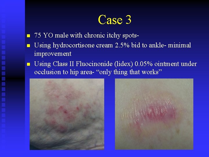 Case 3 n n n 75 YO male with chronic itchy spots. Using hydrocortisone