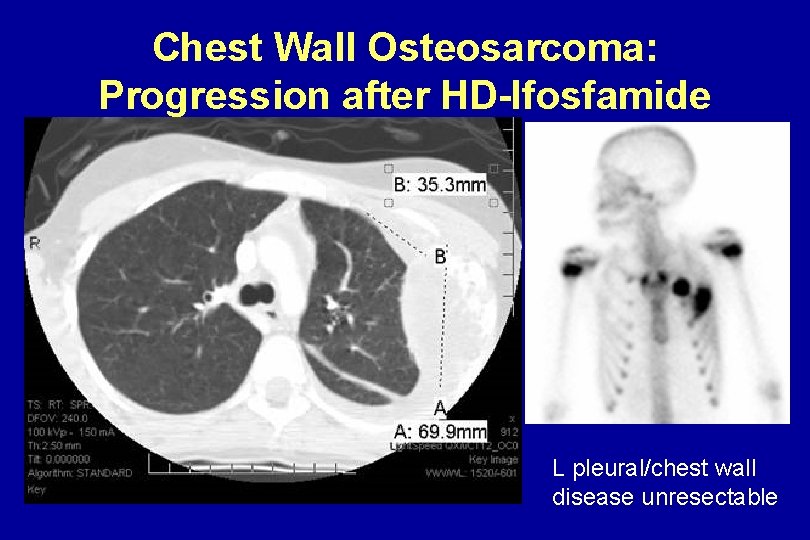 Chest Wall Osteosarcoma: Progression after HD-Ifosfamide L pleural/chest wall disease unresectable Chest Wall Osteosarcoma: Progression after HD-Ifosfamide L pleural/chest wall disease unresectable