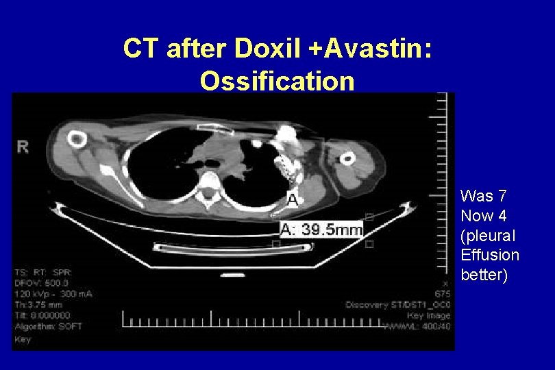 CT after Doxil +Avastin: Ossification Was 7 Now 4 (pleural Effusion better) CT after Doxil +Avastin: Ossification Was 7 Now 4 (pleural Effusion better)