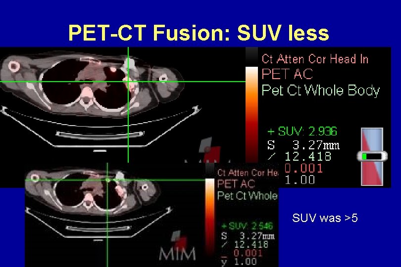 PET-CT Fusion: SUV less SUV was >5 PET-CT Fusion: SUV less SUV was >5