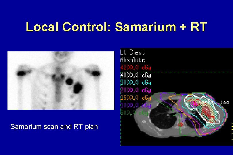 Local Control: Samarium + RT Samarium scan and RT plan Local Control: Samarium + RT Samarium scan and RT plan