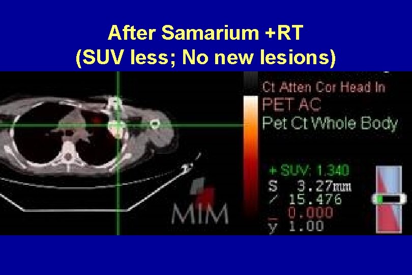 After Samarium +RT (SUV less; No new lesions) After Samarium +RT (SUV less; No new lesions)