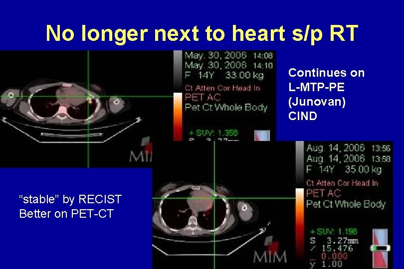 No longer next to heart s/p RT Continues on L-MTP-PE (Junovan) CIND “stable” by No longer next to heart s/p RT Continues on L-MTP-PE (Junovan) CIND “stable” by