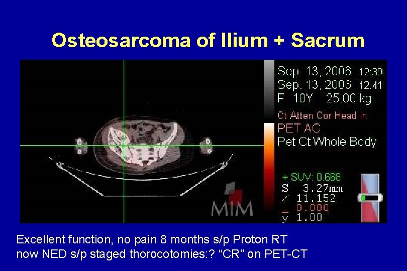 Osteosarcoma of Ilium + Sacrum Excellent function, no pain 8 months s/p Proton RT Osteosarcoma of Ilium + Sacrum Excellent function, no pain 8 months s/p Proton RT
