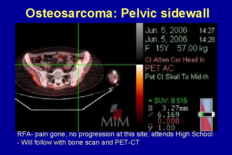 Osteosarcoma: Pelvic sidewall RFA- pain gone, no progression at this site; attends High School Osteosarcoma: Pelvic sidewall RFA- pain gone, no progression at this site; attends High School