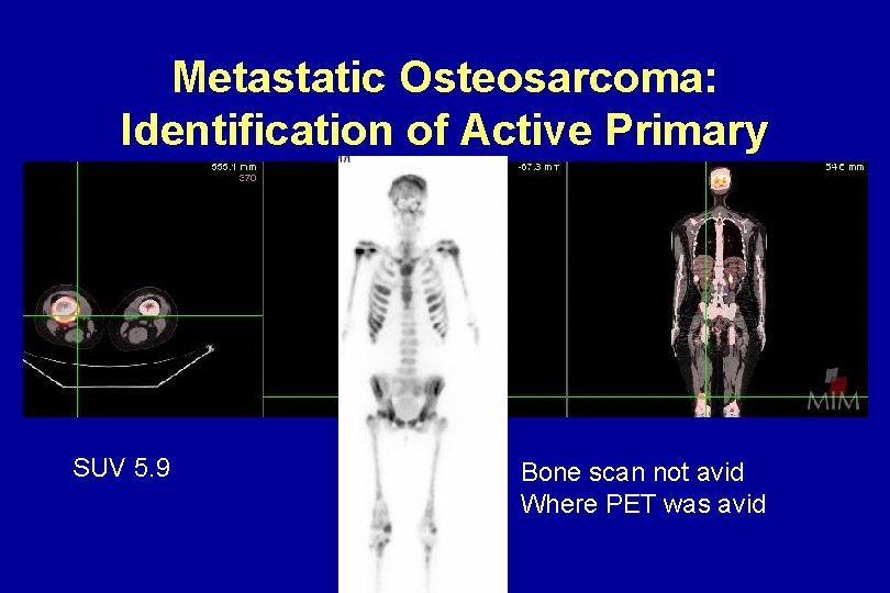 Metastatic Osteosarcoma: Identification of Active Primary SUV 5. 9 Bone scan not avid Where Metastatic Osteosarcoma: Identification of Active Primary SUV 5. 9 Bone scan not avid Where