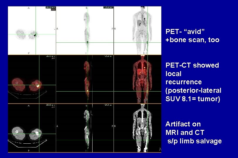 PET- “avid” +bone scan, too PET-CT showed local recurrence (posterior-lateral SUV 8. 1= tumor) PET- “avid” +bone scan, too PET-CT showed local recurrence (posterior-lateral SUV 8. 1= tumor)