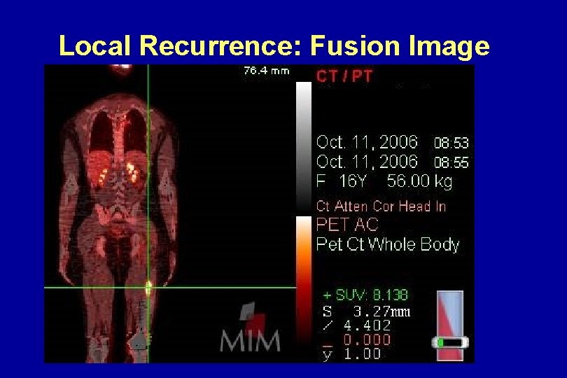 Local Recurrence: Fusion Image Local Recurrence: Fusion Image