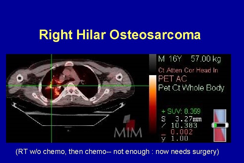 Right Hilar Osteosarcoma (RT w/o chemo, then chemo-- not enough : now needs surgery) Right Hilar Osteosarcoma (RT w/o chemo, then chemo-- not enough : now needs surgery)
