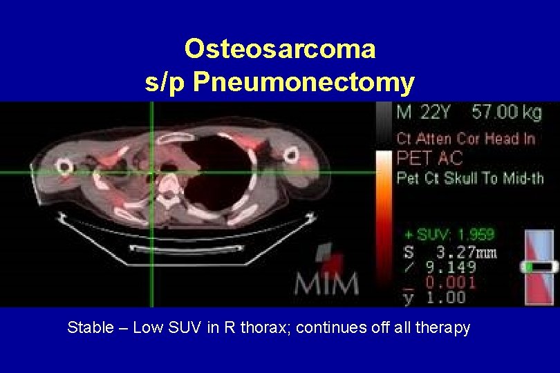 Osteosarcoma s/p Pneumonectomy Stable – Low SUV in R thorax; continues off all therapy Osteosarcoma s/p Pneumonectomy Stable – Low SUV in R thorax; continues off all therapy