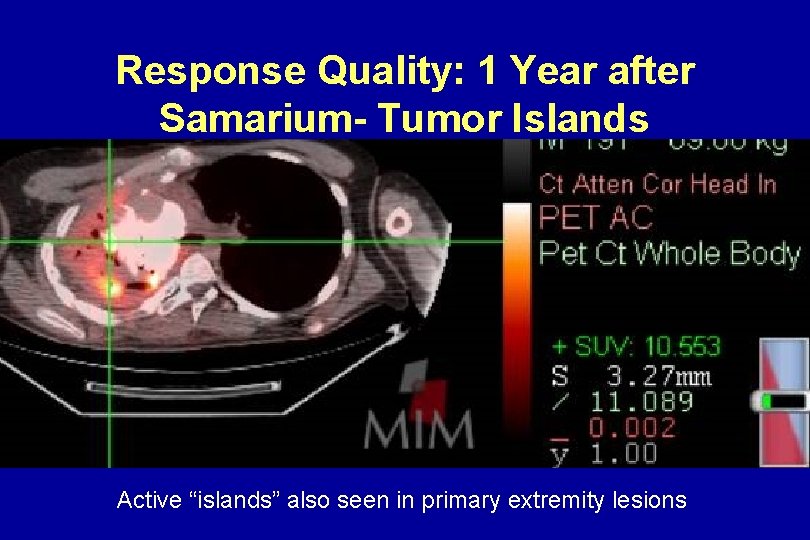Response Quality: 1 Year after Samarium- Tumor Islands Active “islands” also seen in primary Response Quality: 1 Year after Samarium- Tumor Islands Active “islands” also seen in primary