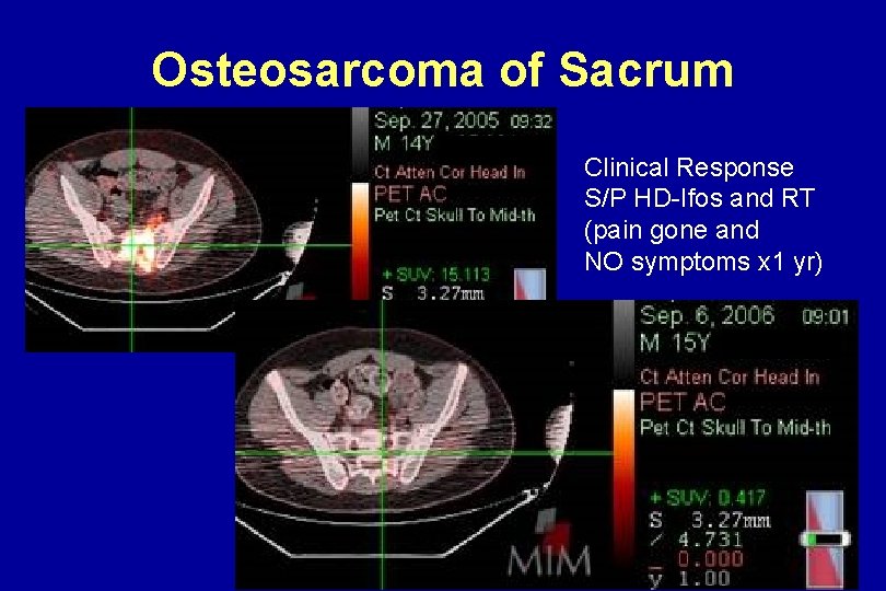 Osteosarcoma of Sacrum Clinical Response S/P HD-Ifos and RT (pain gone and NO symptoms Osteosarcoma of Sacrum Clinical Response S/P HD-Ifos and RT (pain gone and NO symptoms