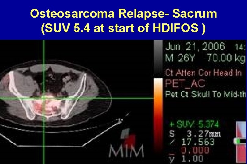 Osteosarcoma Relapse- Sacrum (SUV 5. 4 at start of HDIFOS ) Osteosarcoma Relapse- Sacrum (SUV 5. 4 at start of HDIFOS )