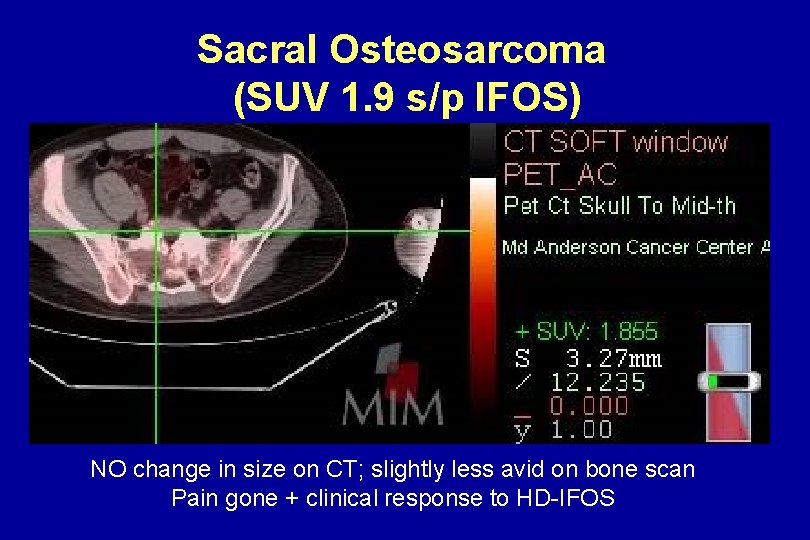 Sacral Osteosarcoma (SUV 1. 9 s/p IFOS) NO change in size on CT; slightly Sacral Osteosarcoma (SUV 1. 9 s/p IFOS) NO change in size on CT; slightly