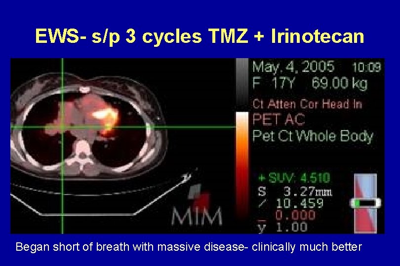 EWS- s/p 3 cycles TMZ + Irinotecan Began short of breath with massive disease- EWS- s/p 3 cycles TMZ + Irinotecan Began short of breath with massive disease-